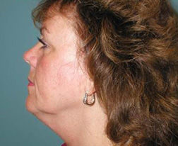 Neck Lift Before