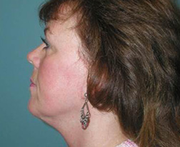 Neck Lift After