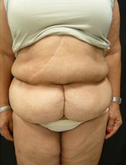 Before Tummy Tuck Results