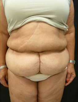 Tummy Tuck Before