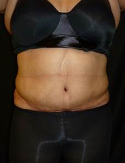 After Tummy Tuck Results