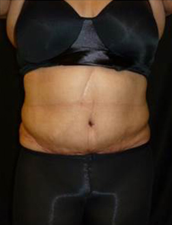 Tummy Tuck After