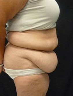 Tummy Tuck Before