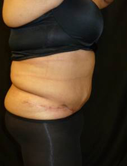 Tummy Tuck After