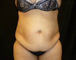 Tummy Tuck Before