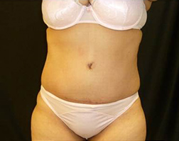 Tummy Tuck After