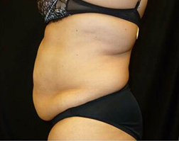 Tummy Tuck Before