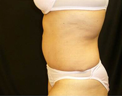 Tummy Tuck After