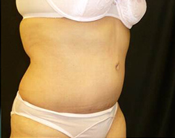 Tummy Tuck After