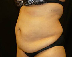 Tummy Tuck Before