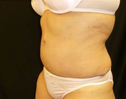 Tummy Tuck After