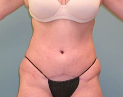 Tummy Tuck After