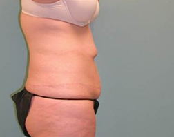 Tummy Tuck Before