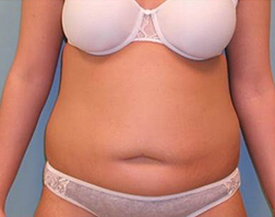 Before Tummy Tuck Results
