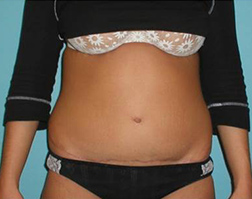 After Tummy Tuck Results