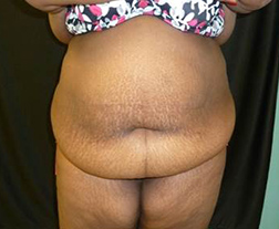 Tummy Tuck Before