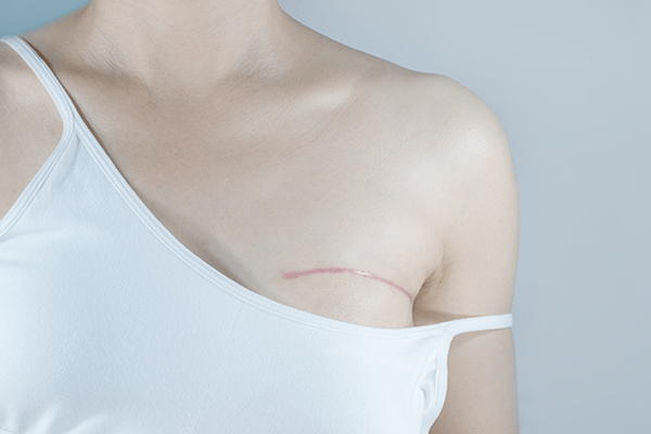 Closeup of a woman in a white tank top with the left strap down revealing a surgical scar indicating breast cancer surgery
